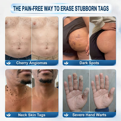 7-Day Skin Tag & Spot Eraser Painless & Scar-Free Advanced Imperfection Removal Rollerball Pen🍓